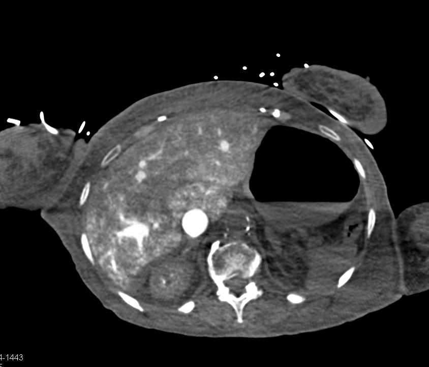 Persistent Contrast in Liver due to Right Heart Failure - CTisus CT Scan