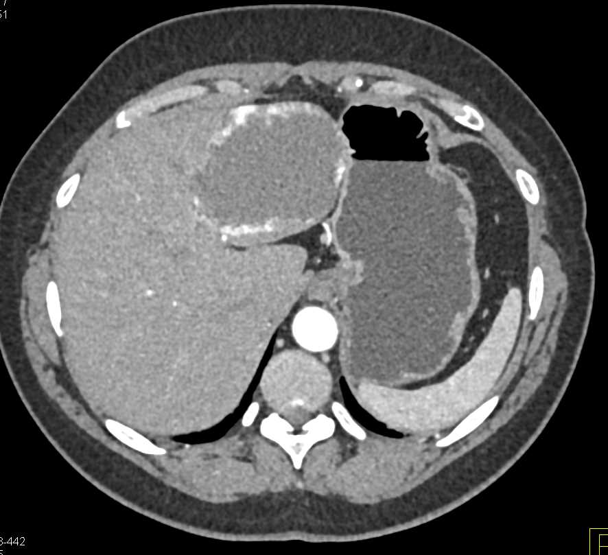 Hepatic Hemangioma - CTisus CT Scan