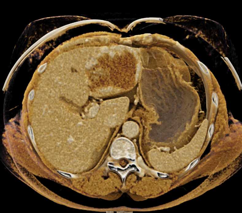 Hepatic Hemangioma with Cinematic Rendering (CR) - CTisus CT Scan