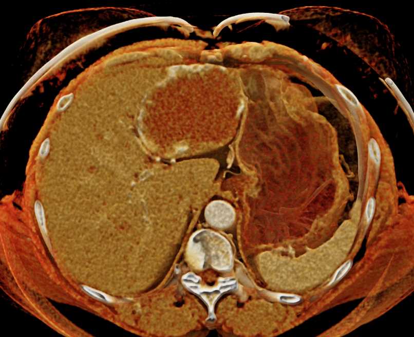 Hepatic Hemangioma with Cinematic Rendering (CR) - CTisus CT Scan