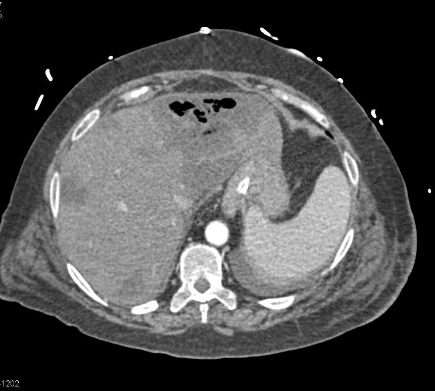 Liver Infarct with Left Lobe Abscess - CTisus CT Scan