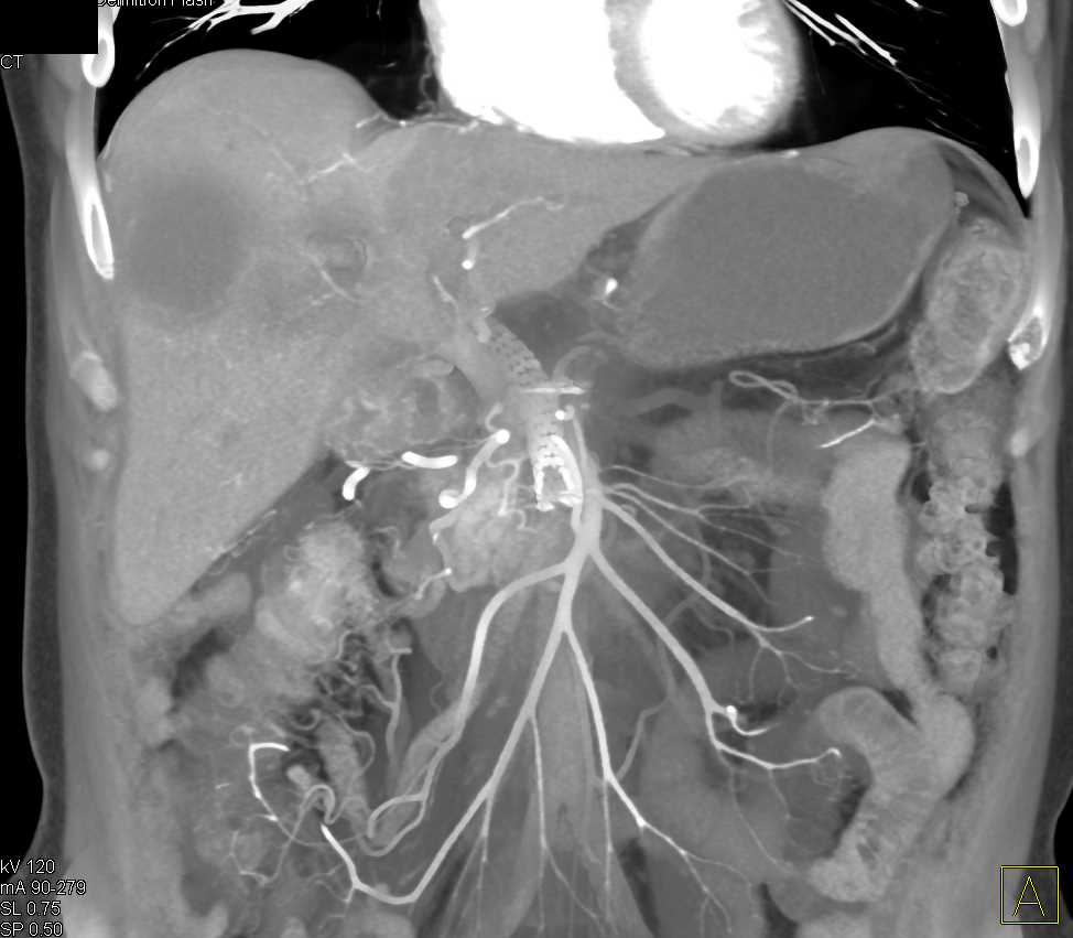 Multiple Liver Abscesses in a Post Op Patient - CTisus CT Scan