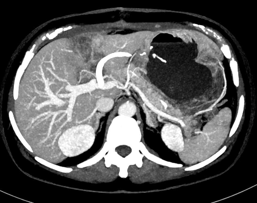 Focal Fat Simulates a Liver Mass - CTisus CT Scan