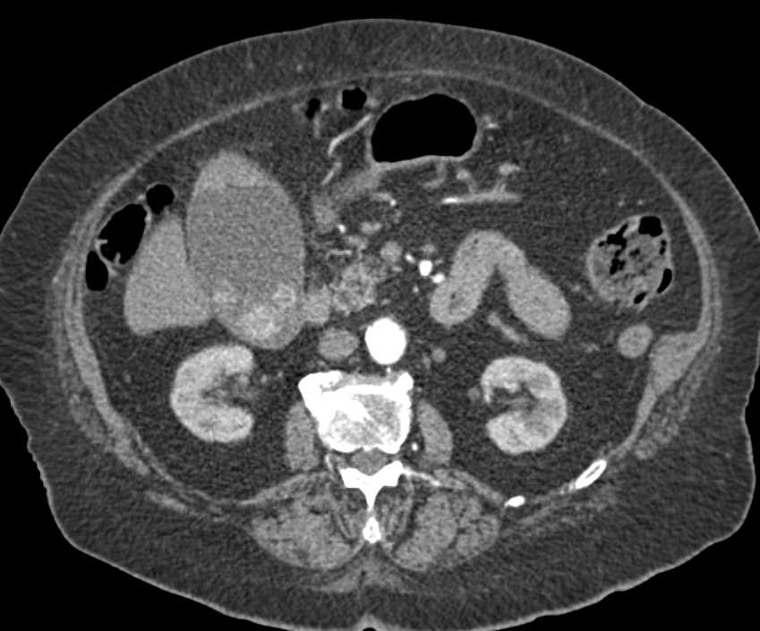 Multiple Gallstones in the Gall Bladder - CTisus CT Scan