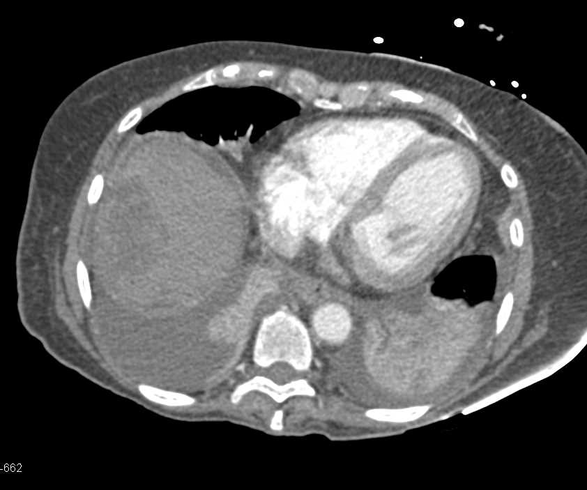 Liver Infarcts with Post Op Complications - CTisus CT Scan