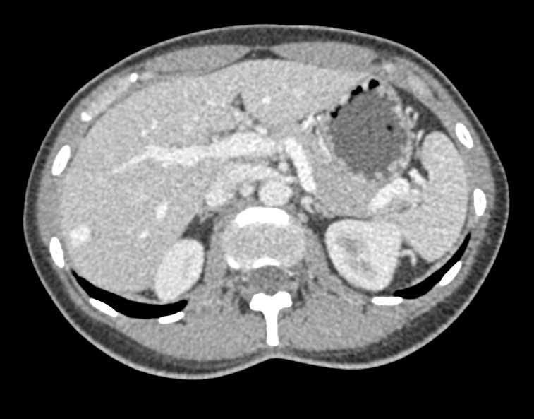 Flash Filling Hemangioma Right Lobe of the LIver - CTisus CT Scan