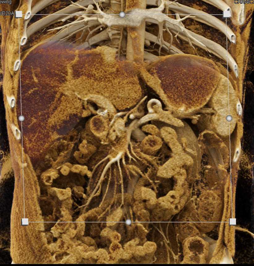 Stent in the Common Bile Duct with Vascular Mapping with Cinematic Rendering - CTisus CT Scan