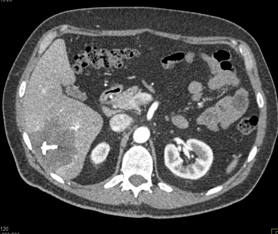 Sclerosed Hemangioma - CTisus CT Scan