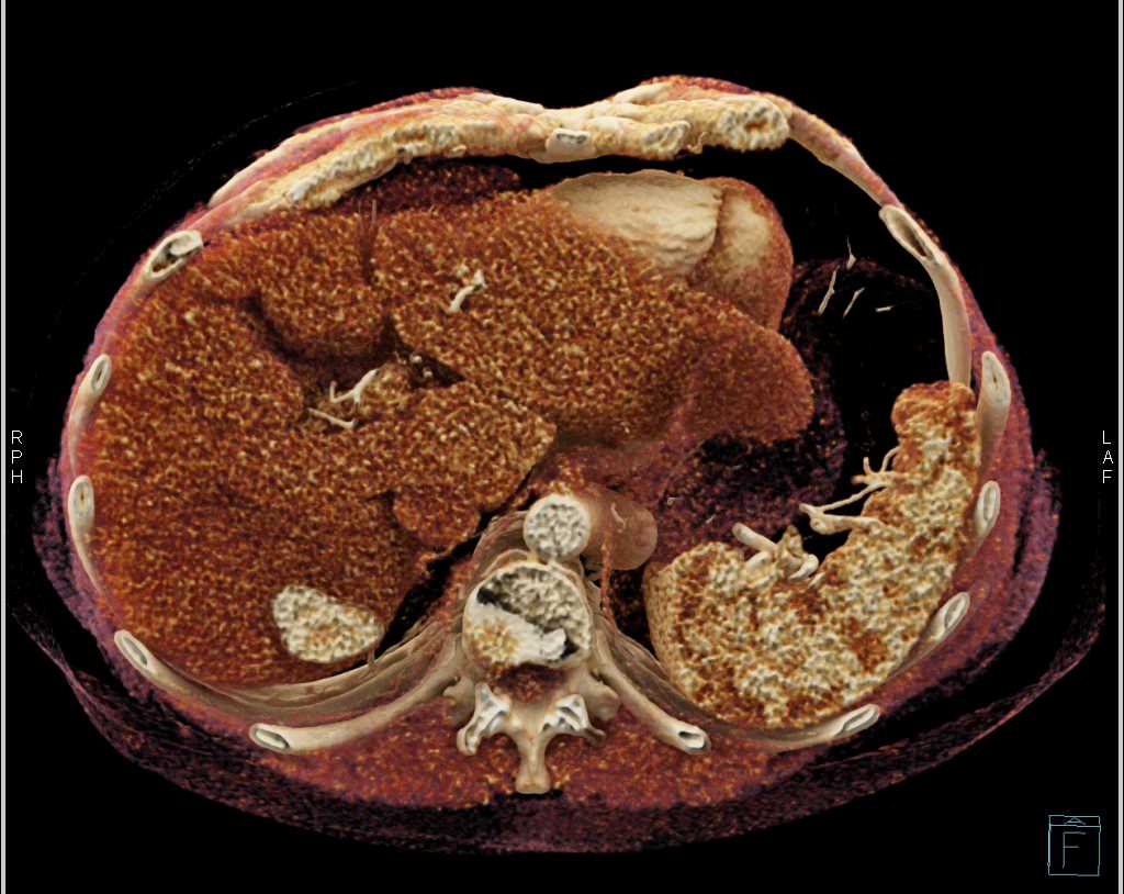 Cirrhosis - CTisus CT Scan