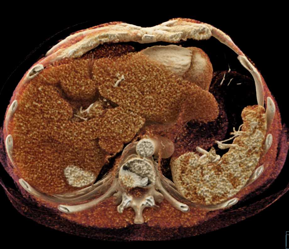 Cirrhosis and Large Caudate Lobe - CTisus CT Scan