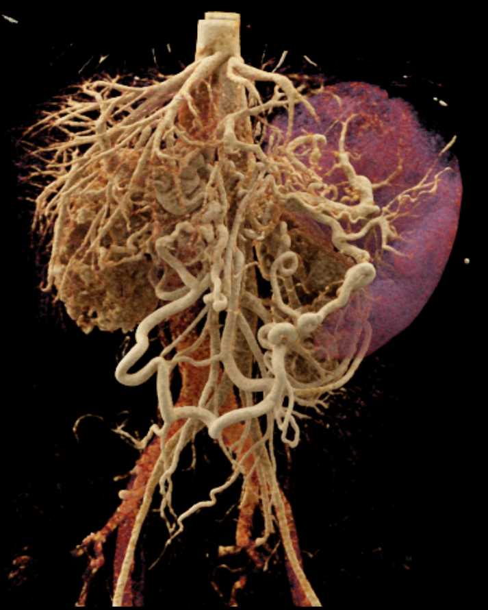 Vascular Mapping of the Liver with Cinematic Rendering - CTisus CT Scan