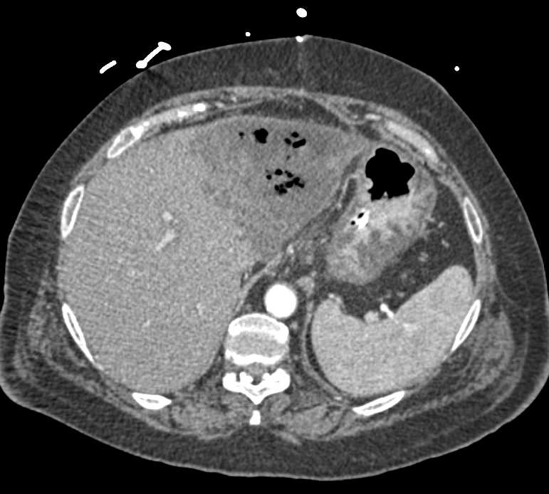 Liver Infarcts - CTisus CT Scan