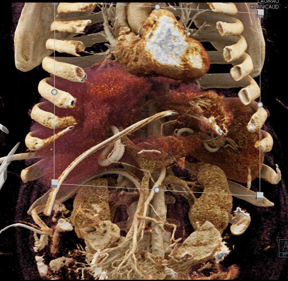 Multiple Liver Infarcts with Cinematic Rendering - CTisus CT Scan