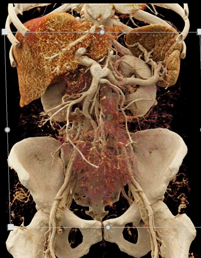 Cinematic Rendering of the Liver and Portal Vein/SMV - CTisus CT Scan