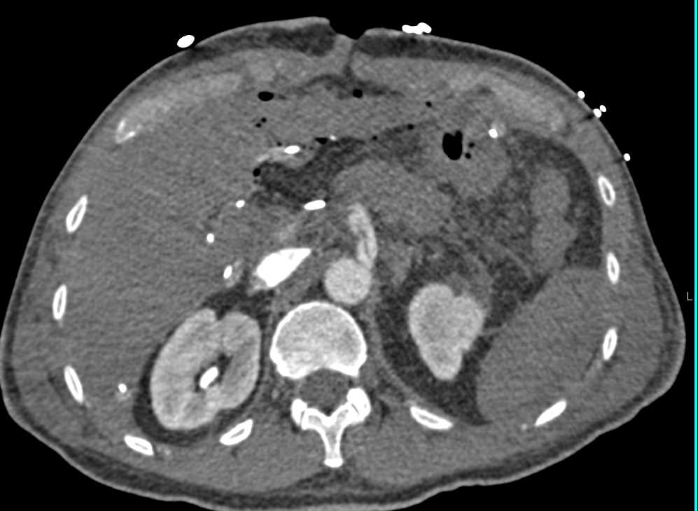 Hepatic Infarcts Post Pancreatic Surgery - CTisus CT Scan