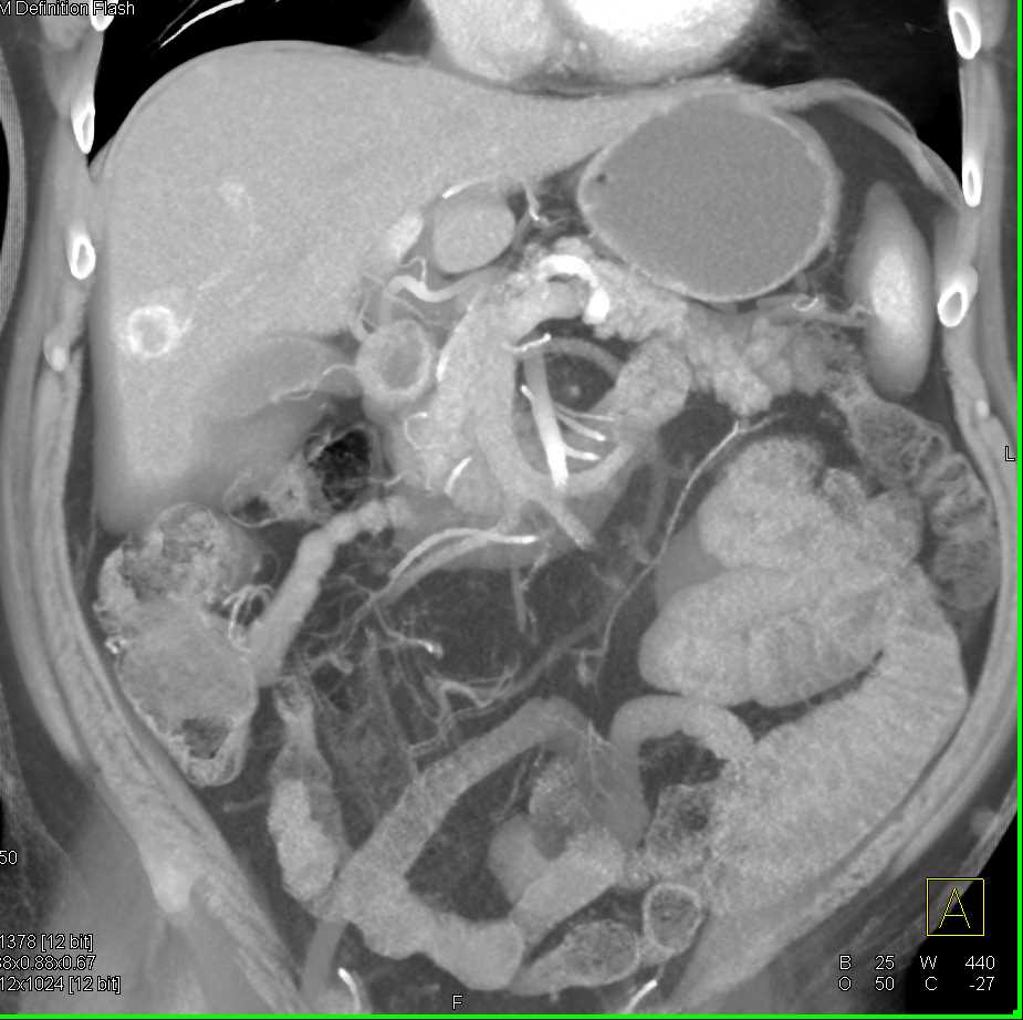 Vascular Metastases to the Liver - CTisus CT Scan