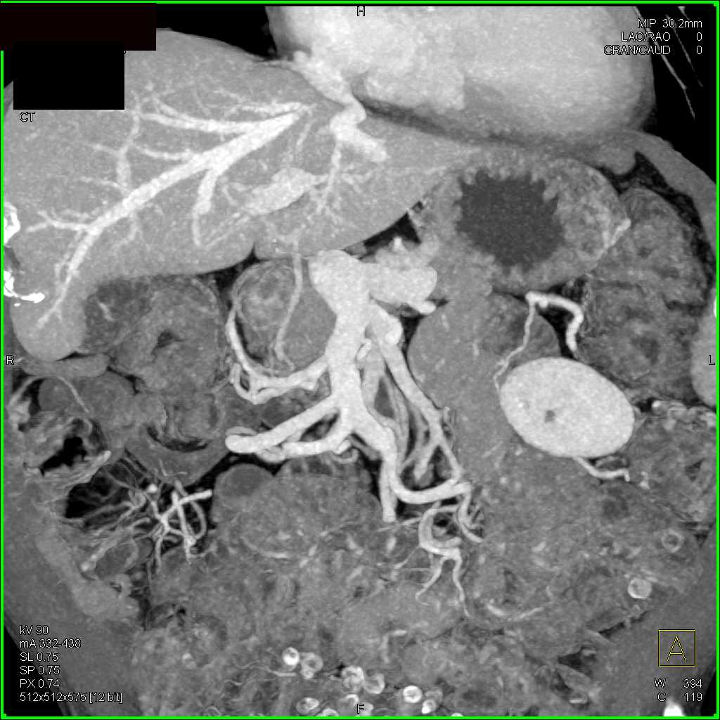 Portal Vein is Patent - CTisus CT Scan