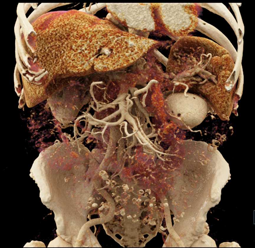 Cinematic Rendering (CR) Mapping of the Liver in a Range of Renderings - CTisus CT Scan