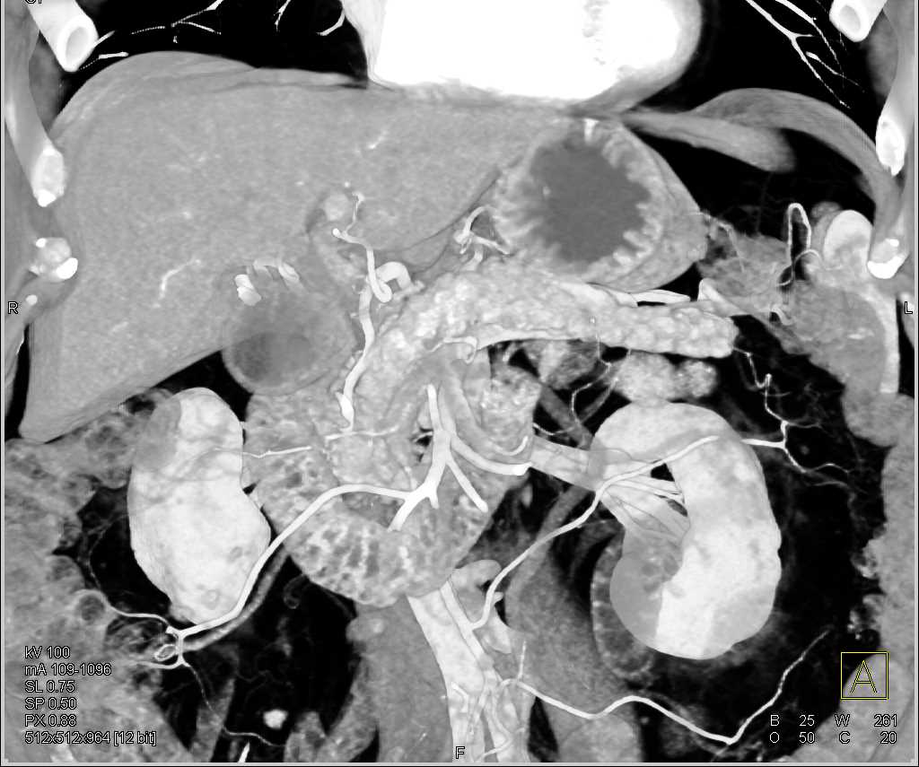 Accessory Right Hepatic Artery off the Superior Mesenteric Artery (SMA) - CTisus CT Scan