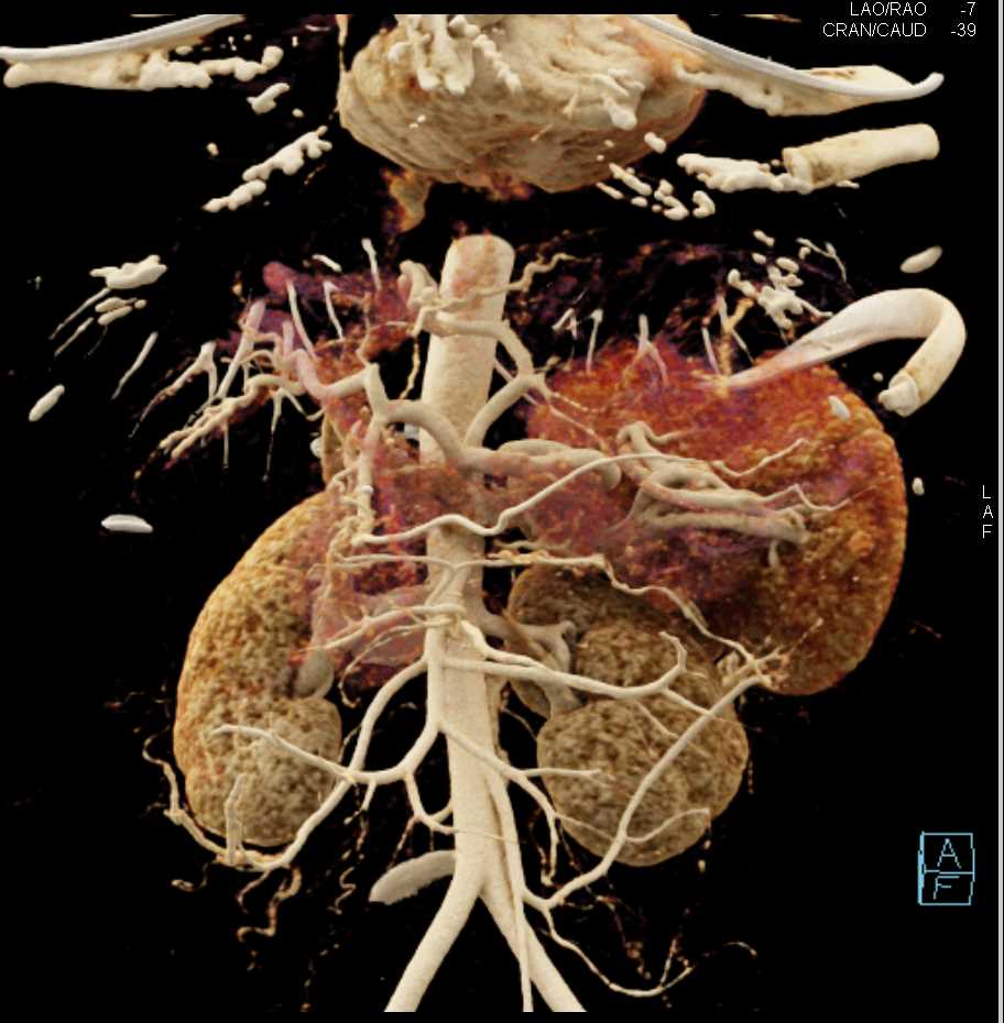 Cirrhosis with Recanalized Umbilical Vein - CTisus CT Scan