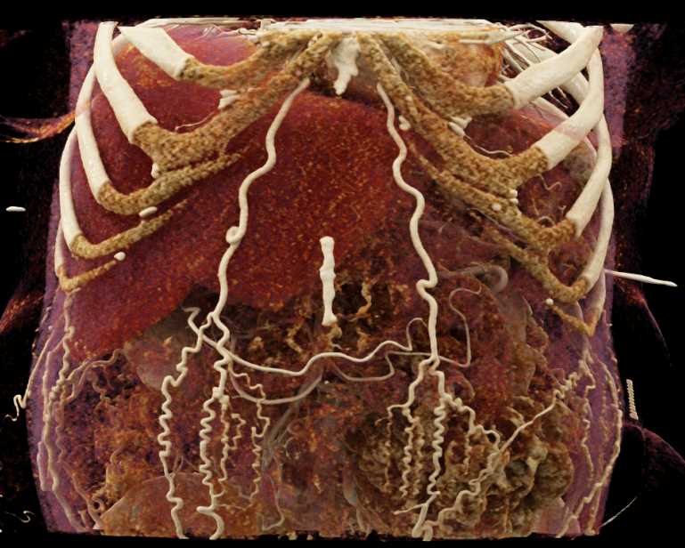 Collateral Vessels in the Abdominal Wall due to Liver Disease - CTisus CT Scan