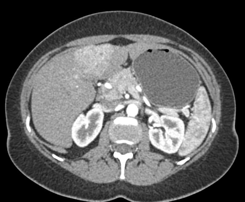 Focal Nodular Hyperplasia (FNH) Left Lobe Liver - CTisus CT Scan