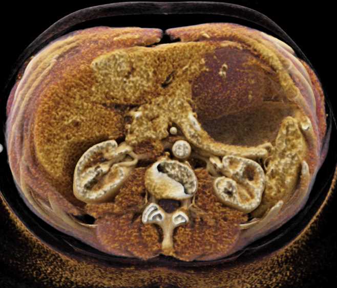 Focal Nodular Hyperplasia (FNH) Left Lobe Liver with Cinematic Rendering - CTisus CT Scan