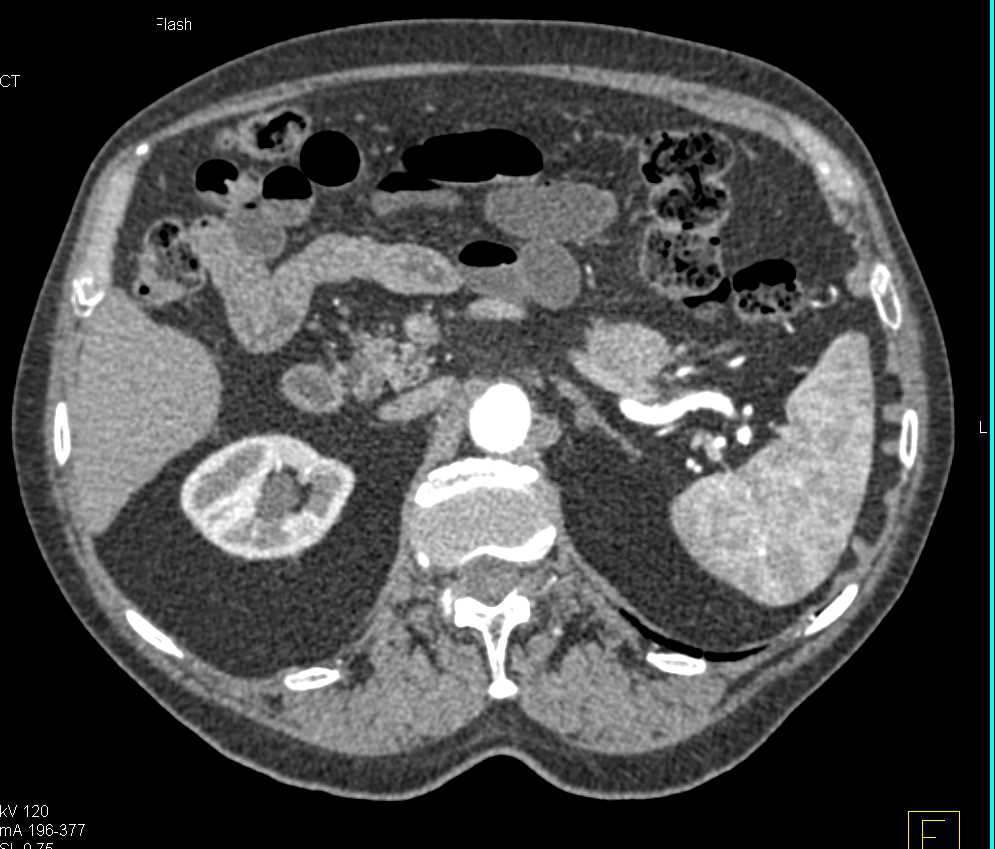 1cm Focal Nodular Hyperplasia (FNH) Liver - CTisus CT Scan