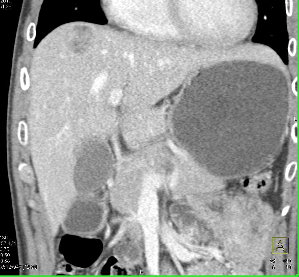 Liver Abscess - CTisus CT Scan