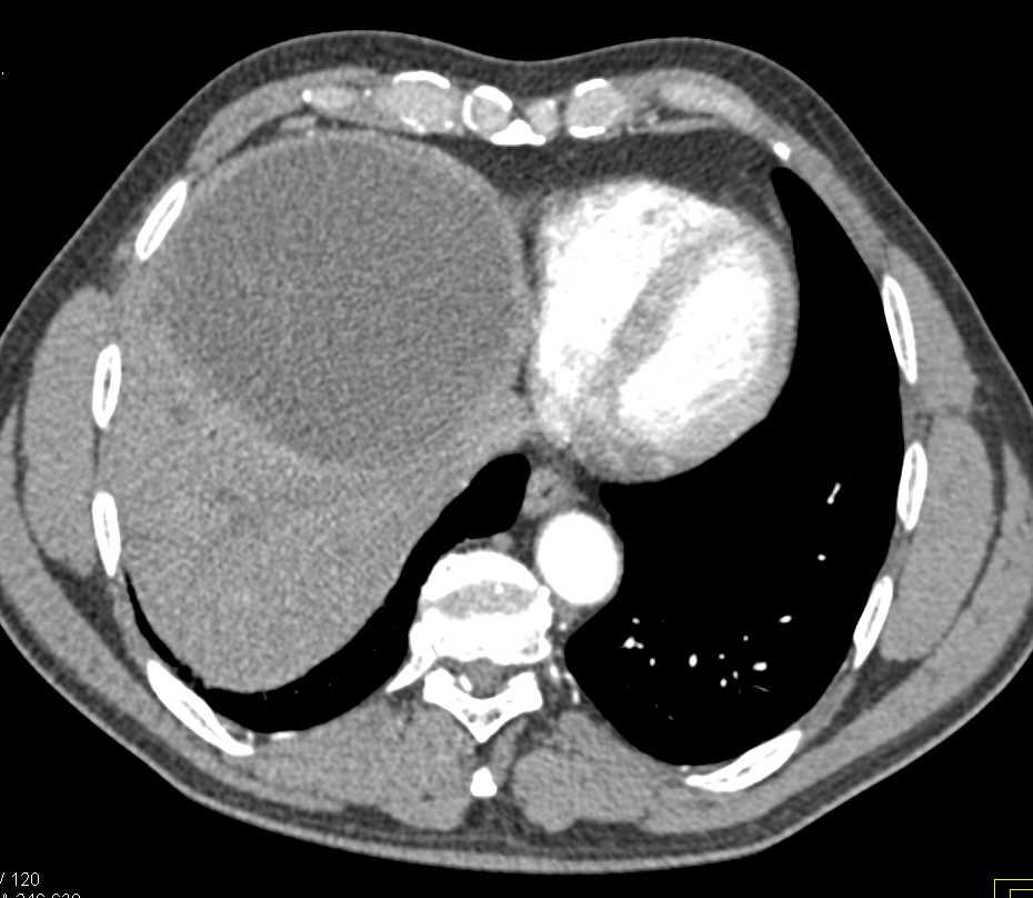 Hepatic Abscess - CTisus CT Scan