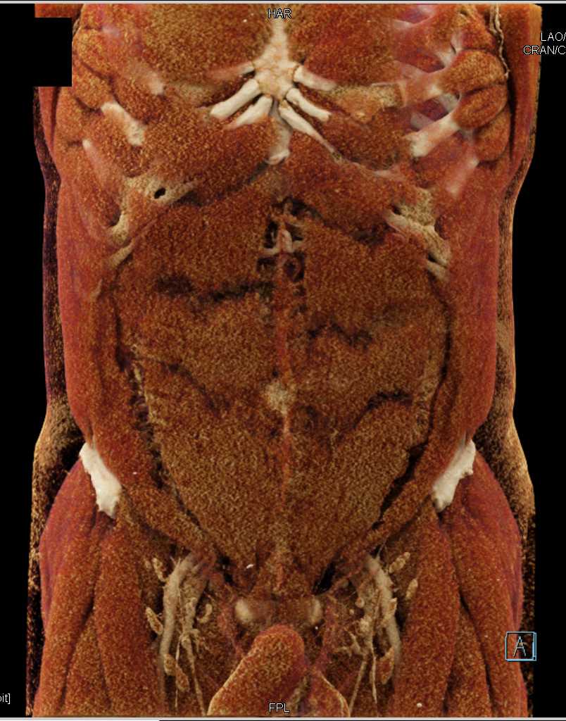 Hepatic Abscess - CTisus CT Scan