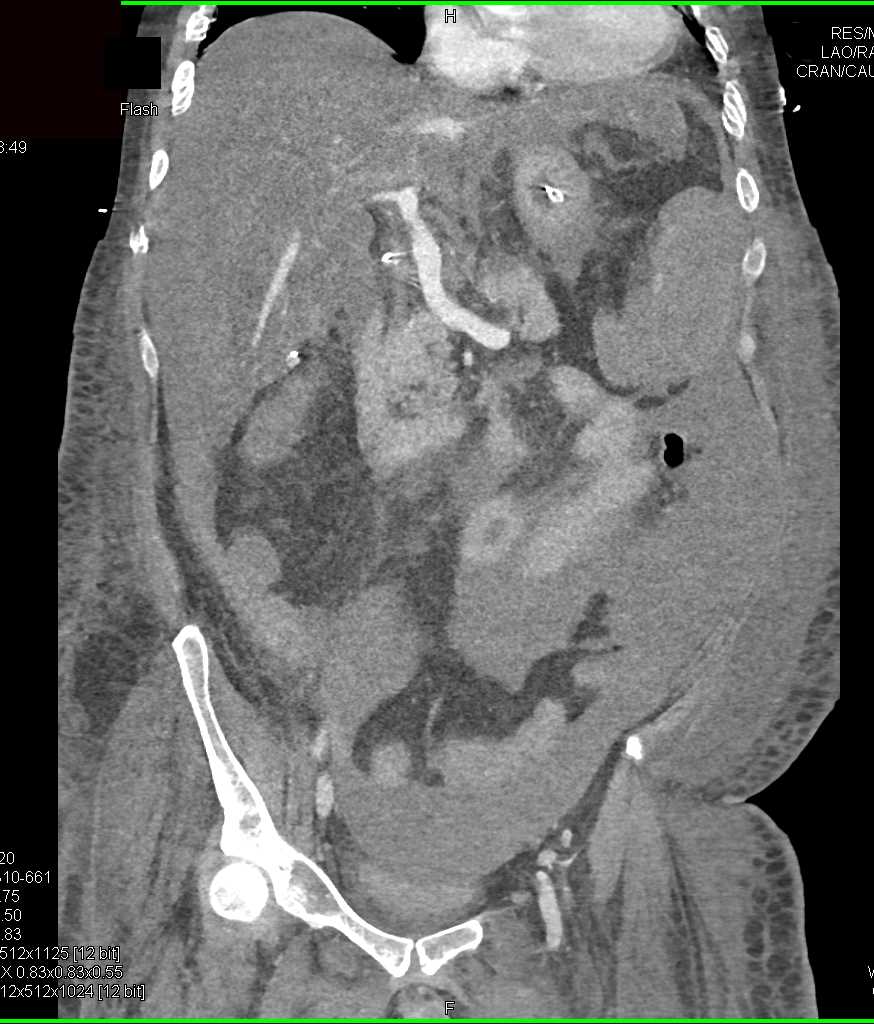 Hepatic Bleed Post Biopsy - CTisus CT Scan