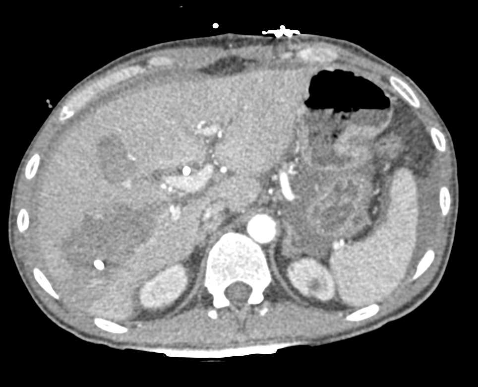 Liver Laceration with Hemoperitoneum - CTisus CT Scan