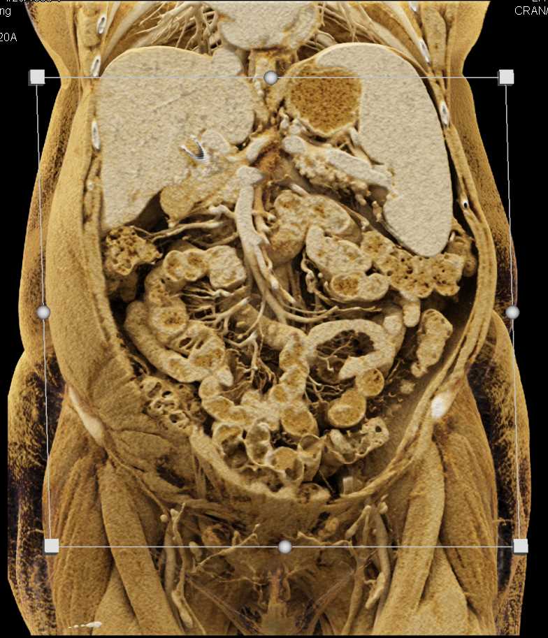 Texture Mapping of the Liver and Spleen - CTisus CT Scan