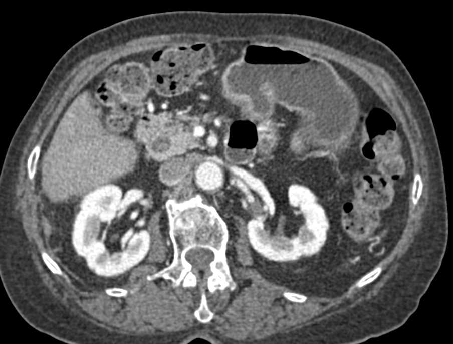 Impacted Stones in the Common Bile Duct - CTisus CT Scan