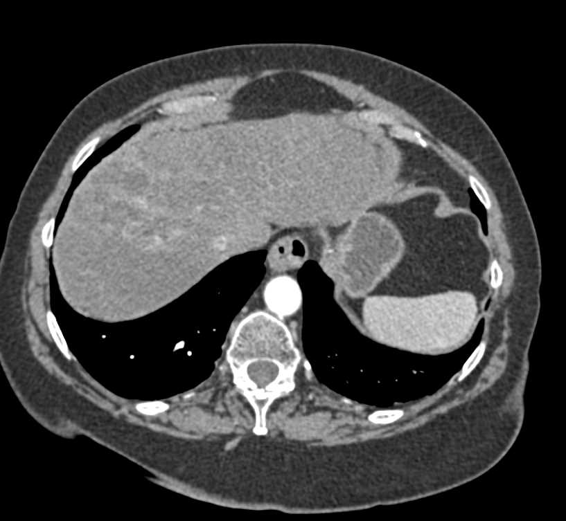 Liver Metastases - CTisus CT Scan