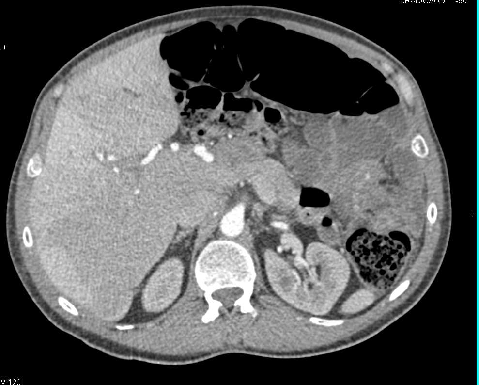 Parenchymal Liver Disease - CTisus CT Scan