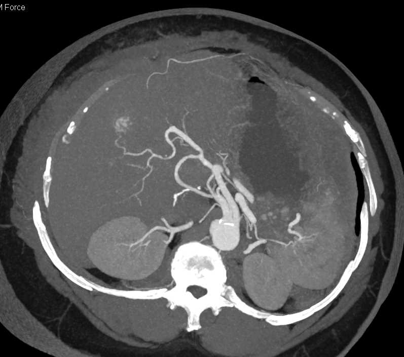 Hepatic Hemangioma - CTisus CT Scan