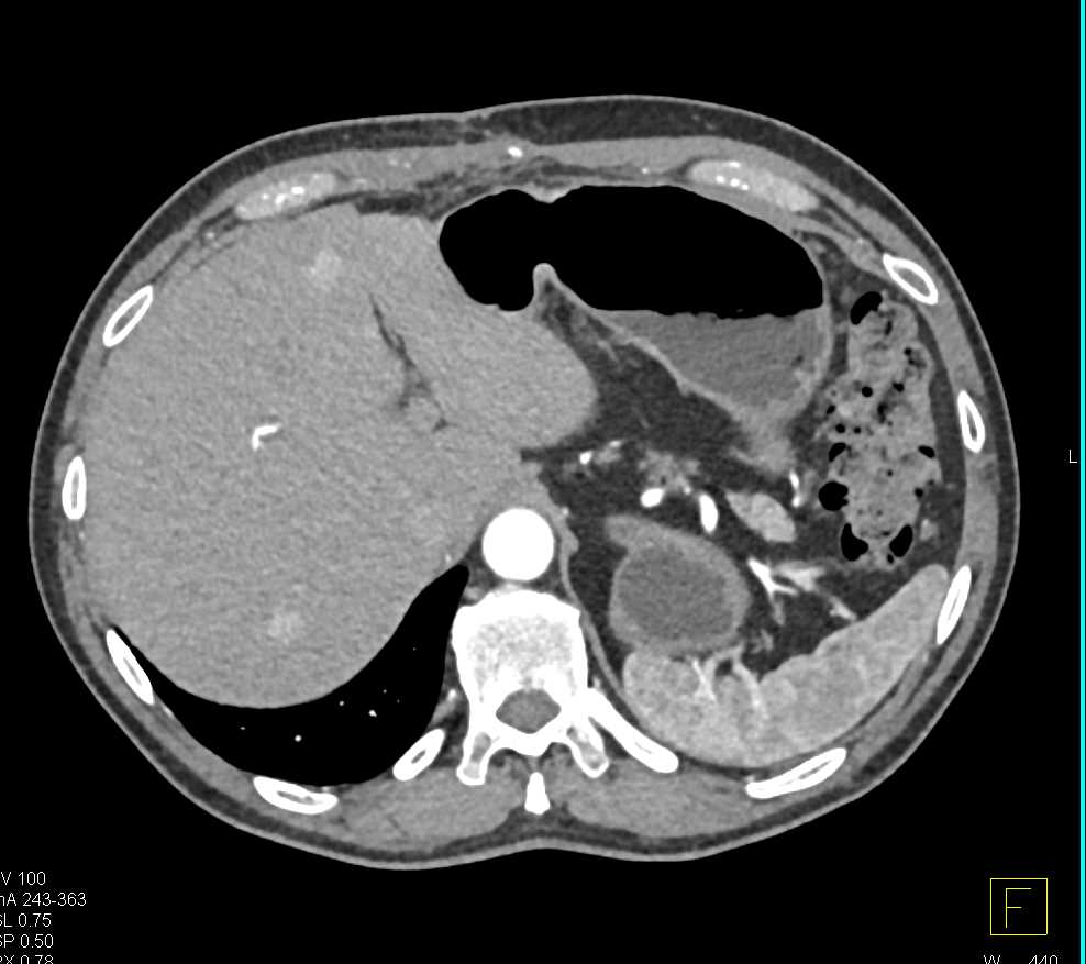 Vascular Liver Metastases - CTisus CT Scan