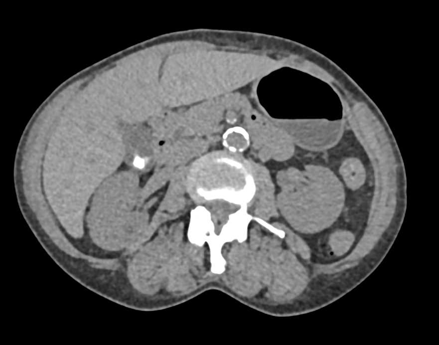 Cholangiocarcinoma - CTisus CT Scan