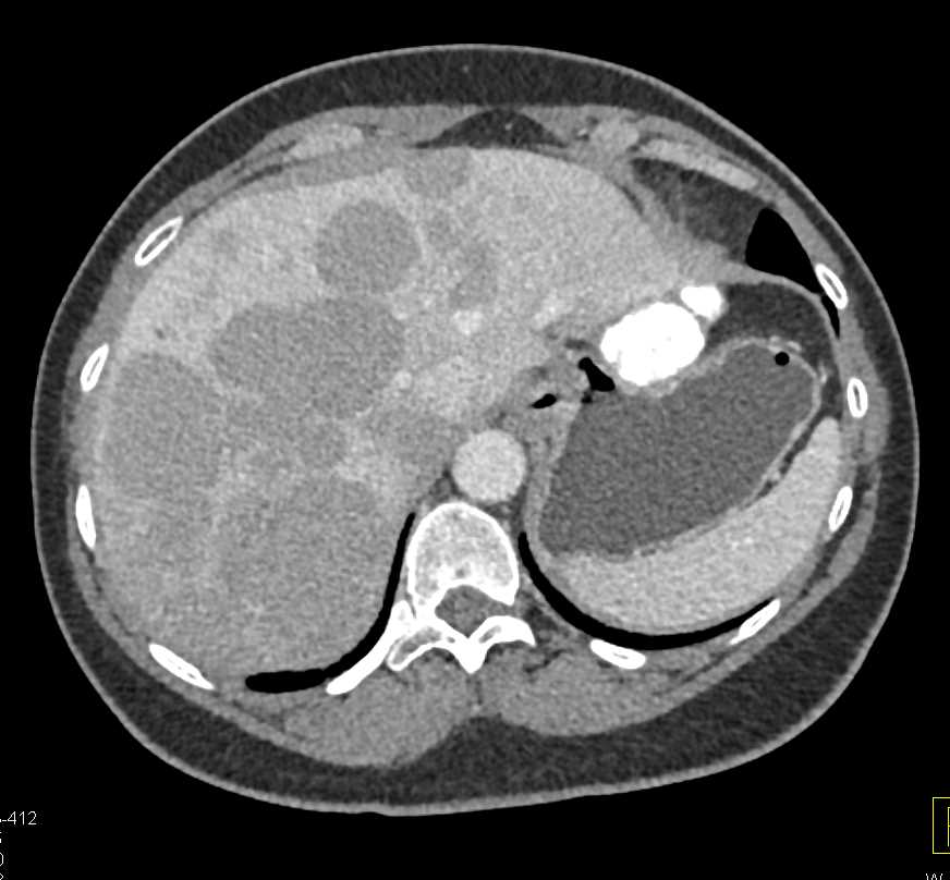 Liver Metastases from Colon Cancer - CTisus CT Scan