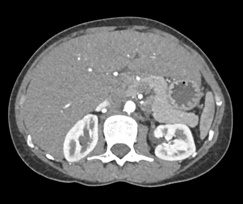 Parenchymal Liver Disease - CTisus CT Scan