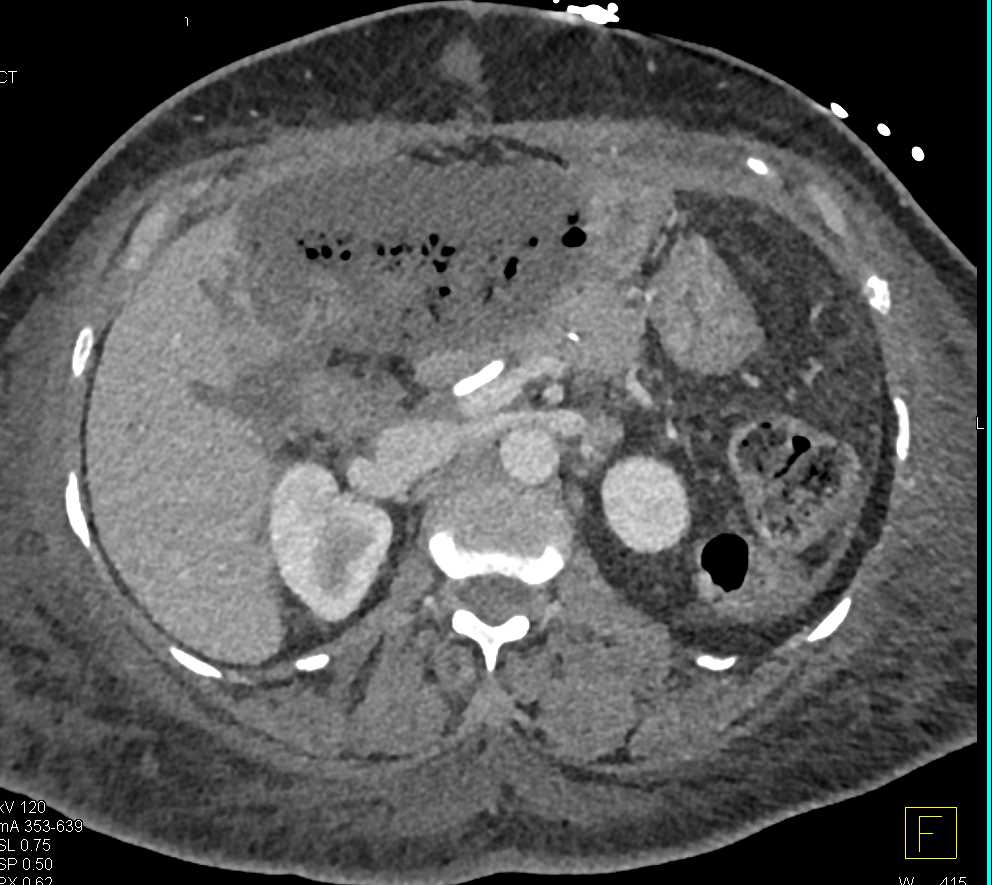 Infarcted Left Lobe Liver s/p Whipples Procedure - CTisus CT Scan