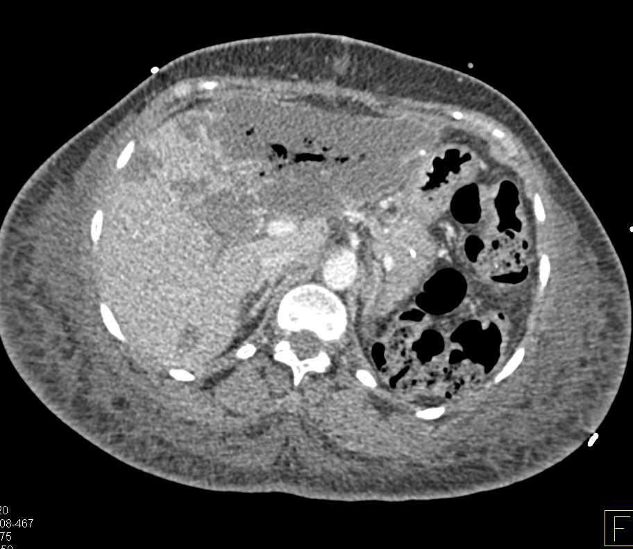 Infarcted Left Lobe Liver s/p Whipples Procedure - CTisus CT Scan