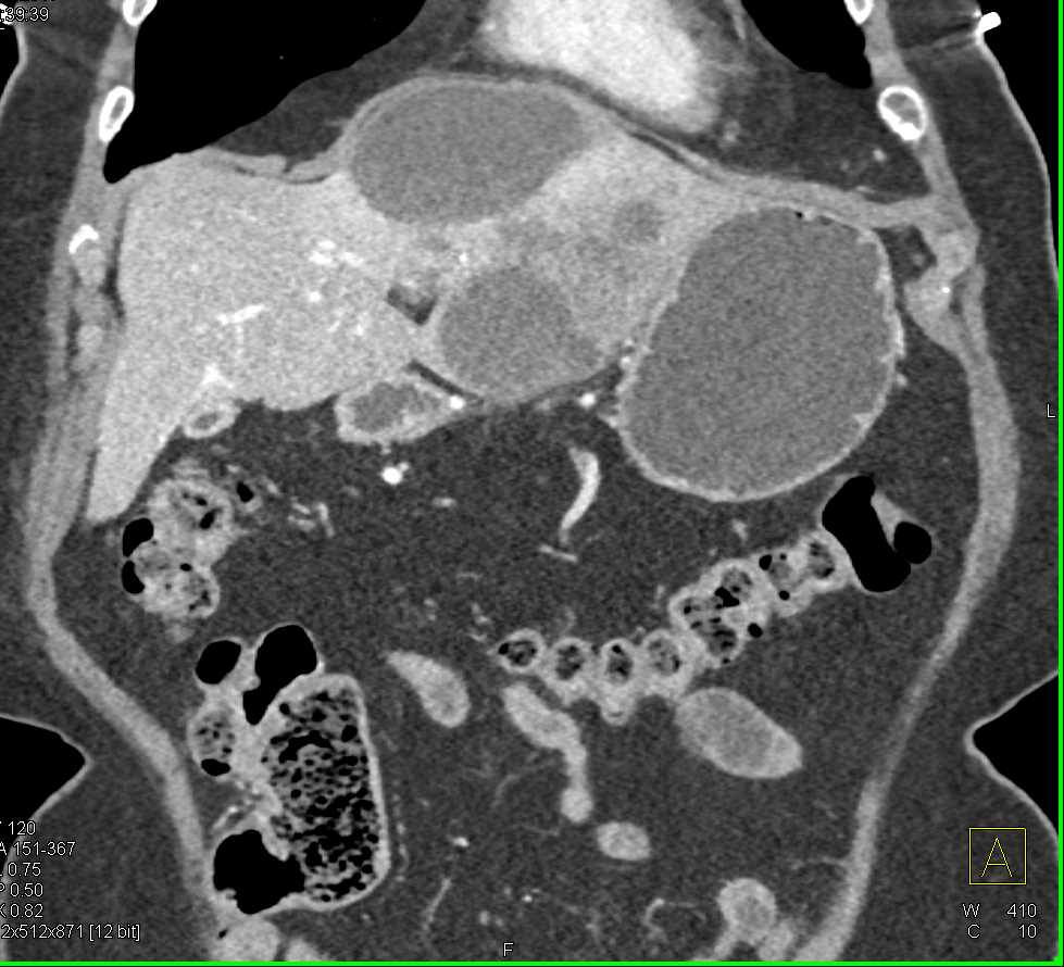 Cholangiocarcinoma Left Lobe of the Liver - CTisus CT Scan
