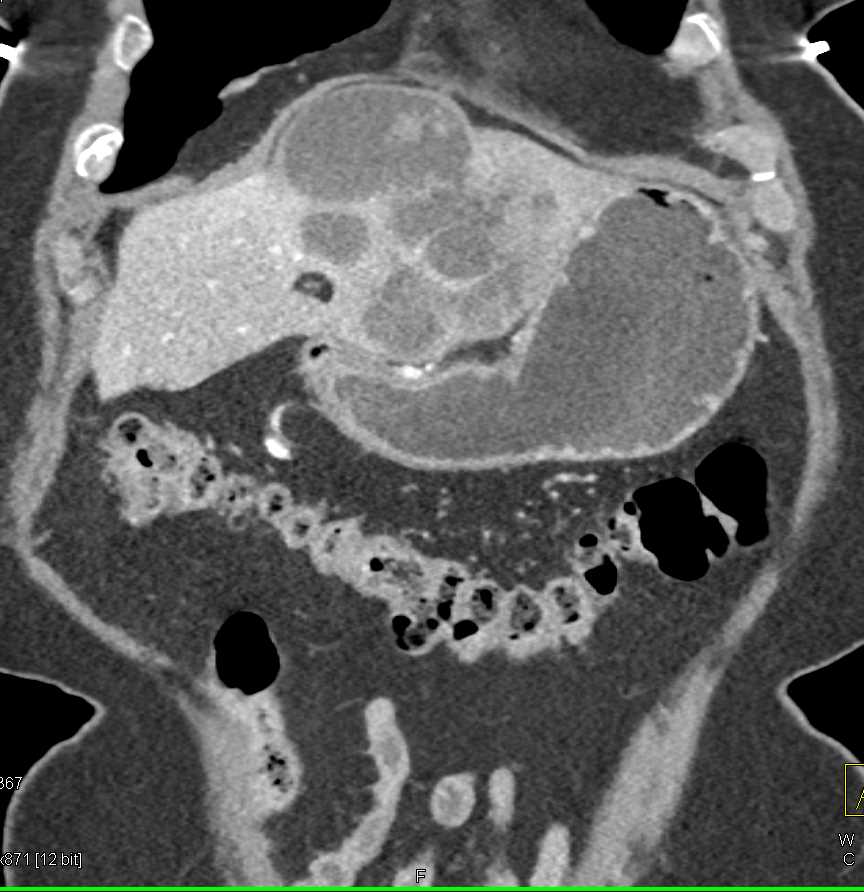 Cholangiocarcinoma Left Lobe of the Liver - CTisus CT Scan