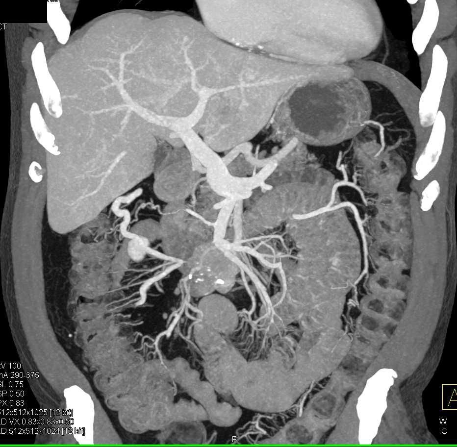 Carcinoid Tumor Root of Mesentery with Liver Metastases - CTisus CT Scan