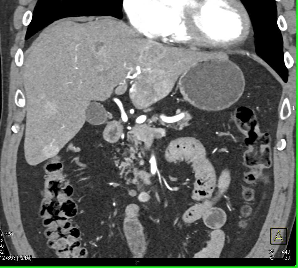 Carcinoid Tumor Root of Mesentery with Liver Metastases - CTisus CT Scan