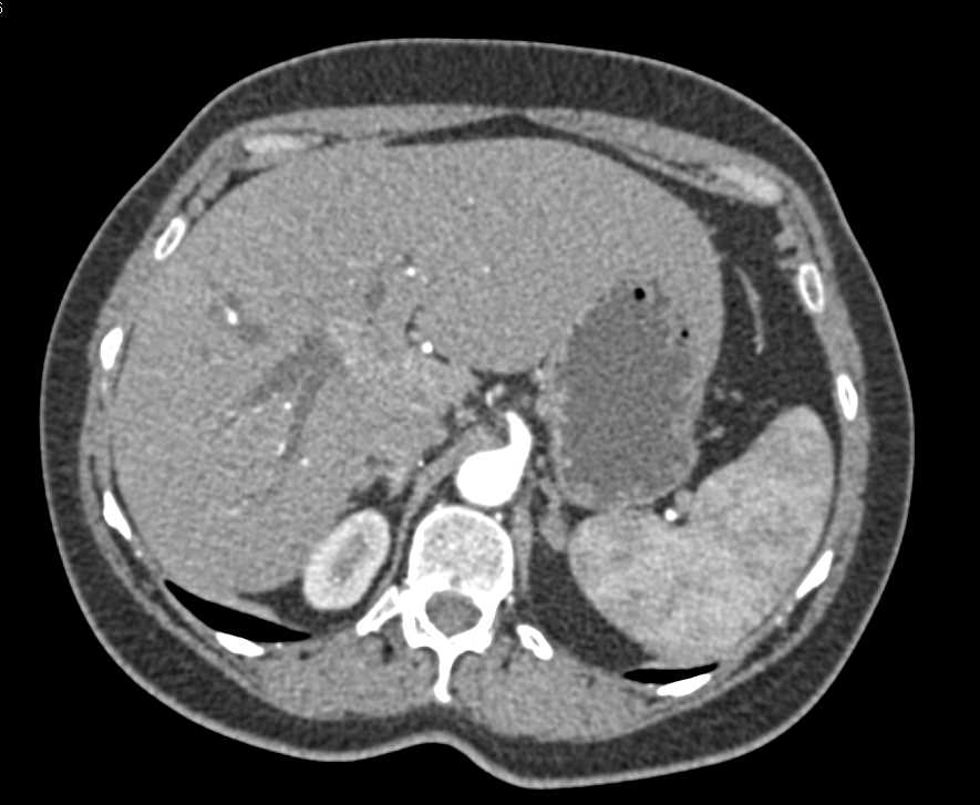 Cholangiocarcinoma - CTisus CT Scan