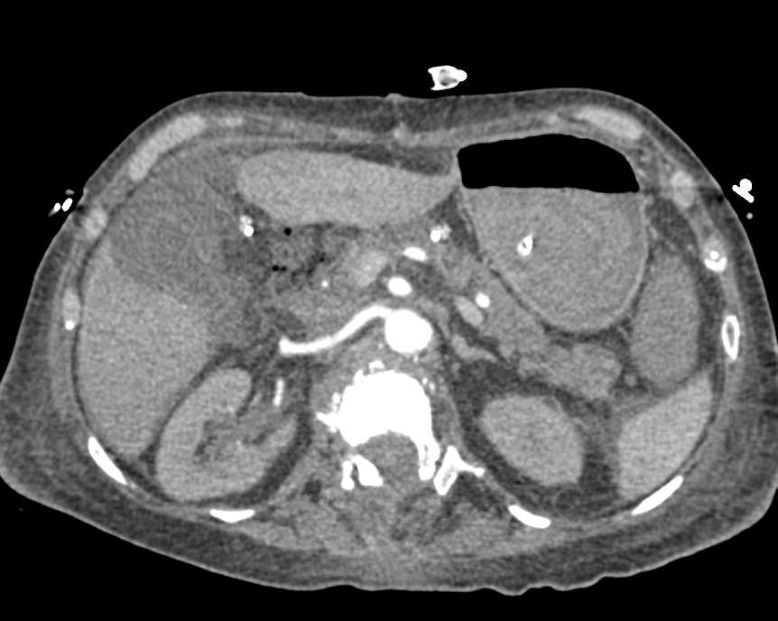 Acute Cholecystitis - CTisus CT Scan